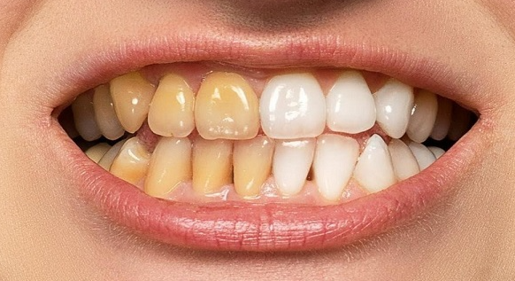 طرق طبيعية لتبييض الأسنان… ما الذي ينفع فعلاً؟ 