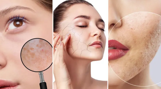 حمض الغليكوليك أم اللكتيك ..  إليكم الأفضل للبشرة الحساسة