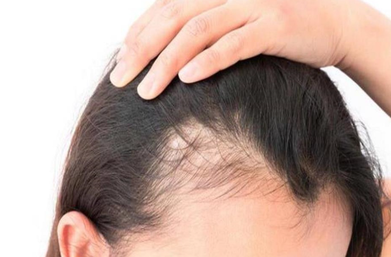 وصفة طبيعية لتقوية الشعر وخصوصاً مقدمة الرأس 