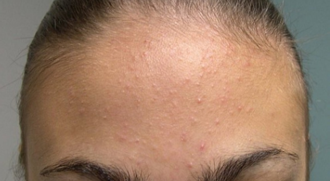 كيف تتخلصين من الحبوب الصغيرة أعلى الجبين بخطوات بسيطة تعيد لبشرتك إشراقتها الطبيعية؟