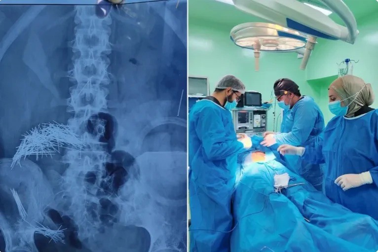 استخراج 214 إبرة ودبوسا من بطن رجل في العراق