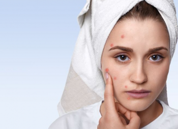 علاج حبوب الوجه في المنزل بخلطات طبيعية آمنة وفعالة على البشرة