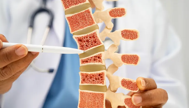 هشاشة العظام في رمضان ..  التعويض الآمن والمدروس 