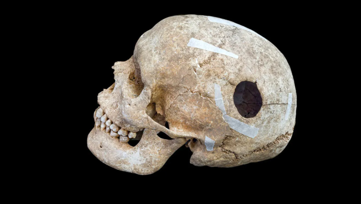 علماء آثار يكشفون دليلاً على أقدم عملية جراحية بالمخ في العالم