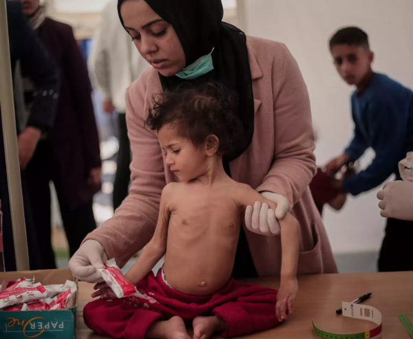 الأمم المتحدة: 95 ألف حالة سوء تغذية في غزة 