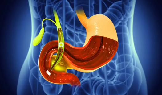 مرضى المرارة في رمضان ..  اختيار الطعام سر الراحة