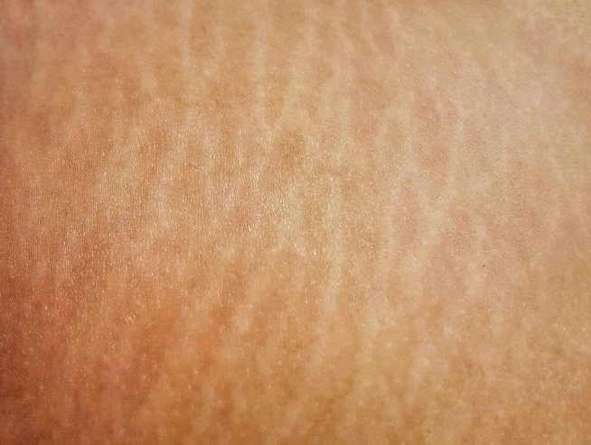 وداعاً لخطوط الجسم: أحدث تقنيات 2026 للتخلص من السترتش ماركس واستعادة نعومة بشرتك