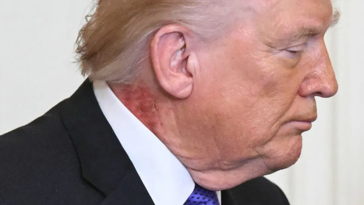 بقعة حمراء في رقبة ترامب تثير التكهنات