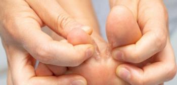 كيف نعالج الفطريات بين أصابع القدم