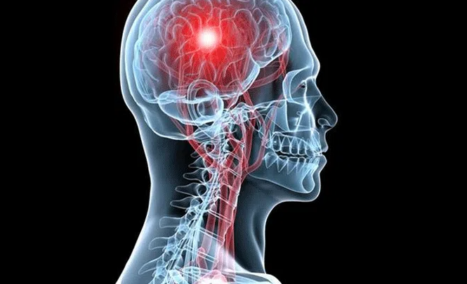 السكتة الدماغية ..  ما هي وما الأعراض التي يجب الانتباه إليها؟