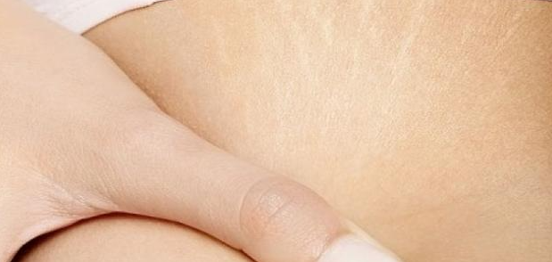 خلطات طبيعية للحد من علامات التمدّد المزعجة