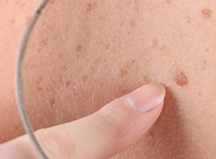 روسيا تبدأ استخدام أول لقاح  لعلاج سرطان الجلد